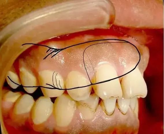 咬合創傷六步檢查法